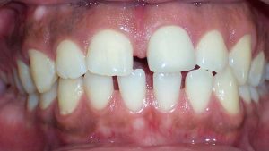 ClearCorrect® - Case 02 - Before